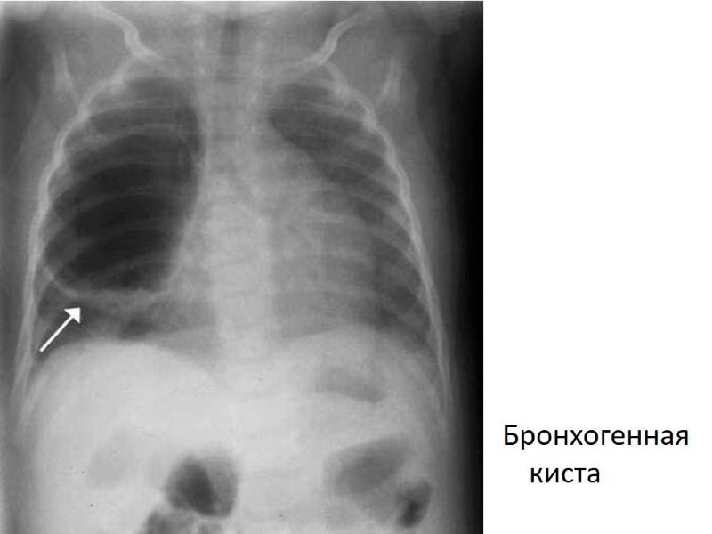 Бронхогенная киста